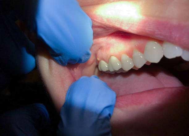 Best Knocked-Out Tooth Emergency  in Hillsboro, WI