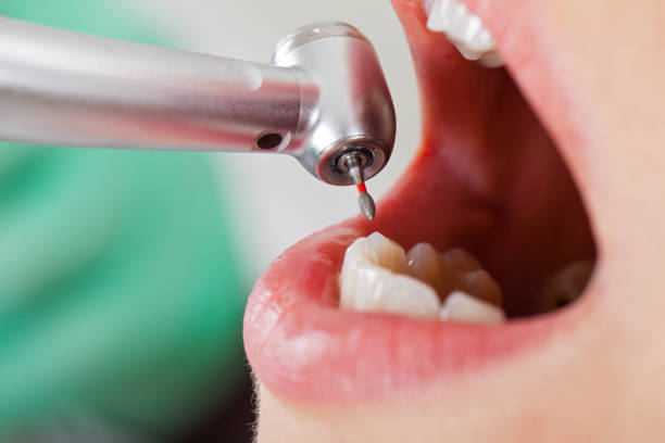 Emergency Dental Filling Replacement in WI